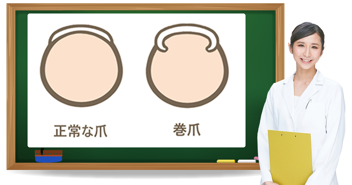 巻き爪とは？症状・原因・予防方法