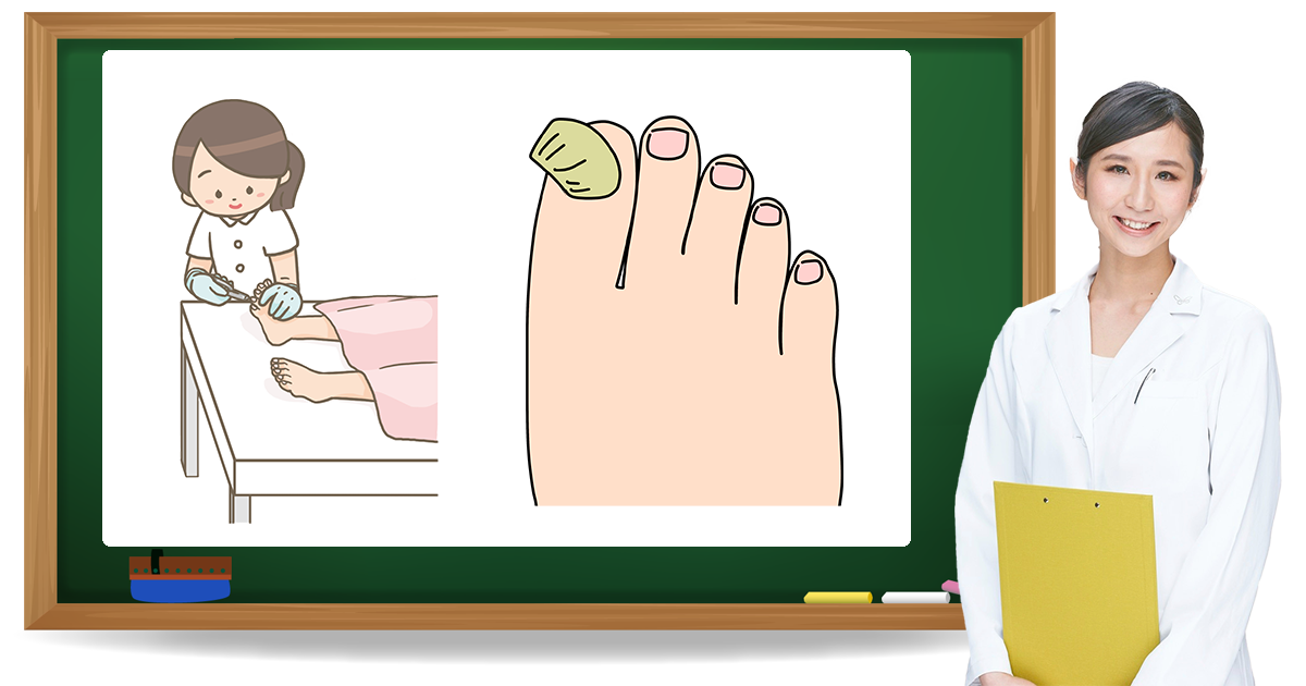 肥厚爪とは？症状・原因・予防方法