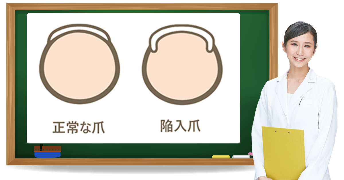 陥入爪とは？症状・原因・予防方法